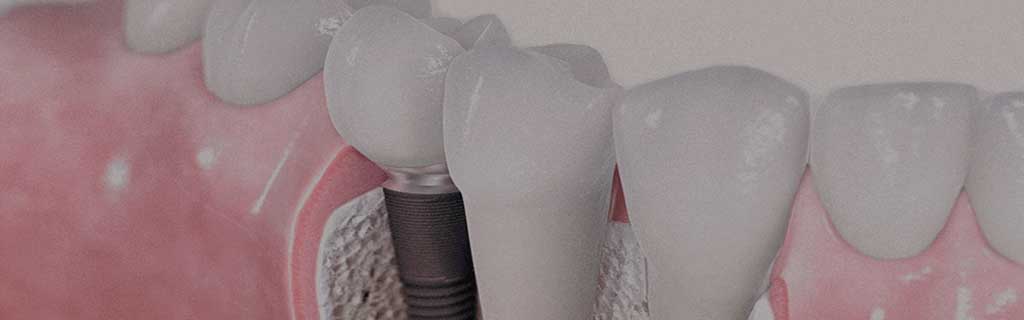 implantes dentales badalona